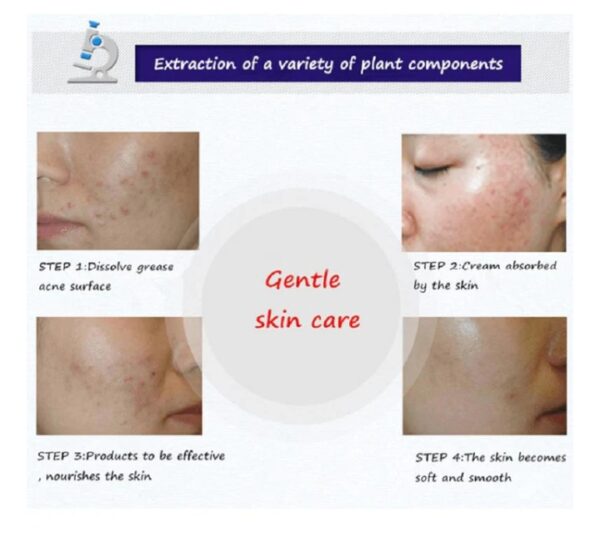 BIOAQUA Anti Acne Cream Acne Scar Removal Cream - Image 3