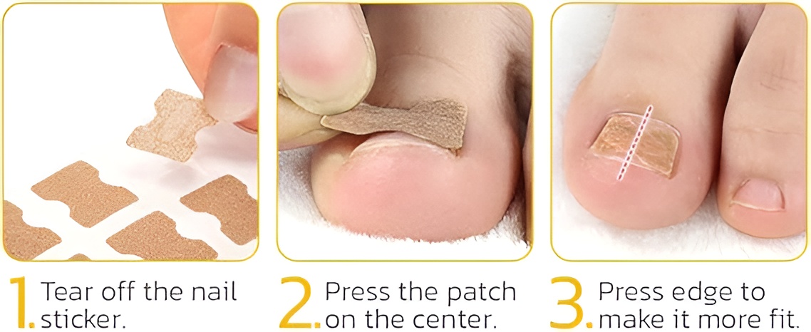 30 Pcs - Glue Free Ingrow Toenail Corrector Stickers | Ingrown Toe Nail Pain Reliever Patches - Image 12